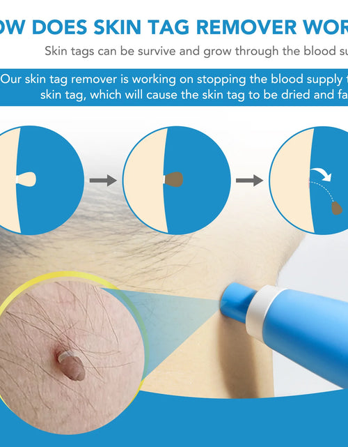 Load image into Gallery viewer, 2 IN 1 Auto Skin Tag Remover Kit Micro Skin Tag Removal Device Adult Mole Stain Wart Remover Face Care Beauty Tools Dropshipping
